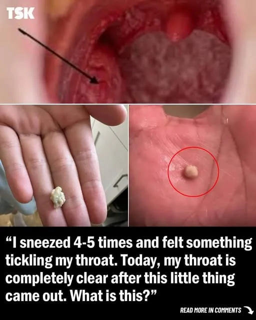 Here’s what you need to know about tonsil stones – the weird pimple-like growths in your throat